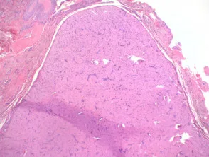 Angioleiomyoma-histologie