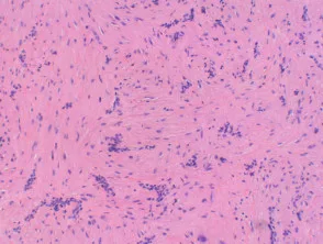 Angioleiomyoma-histologie