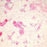 angiolipoma-fig-1__protectwyjqcm90zwn0il0_focusfillwzi5ncwymjisingildfd-5233231-1615781-jpg-6274882