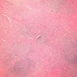 angiolymphoid-hyperplasia-figure-1__protectwyjqcm90zwn0il0_focusfillwzi5ncwymjisingildfd-1588413-6658676-jpg-8128518