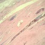angiomatoid-fibrous-histiocytoma-figure-1__protectwyjqcm90zwn0il0_focusfillwzi5ncwymjisinkildrd-9637560-1623632-jpg-6872124