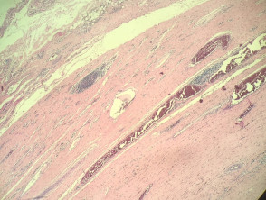 Histiocitoma fibroso angiomatoide