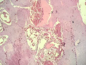 Histiocitoma fibroso angiomatoide