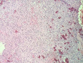 Histiocitoma fibroso angiomatoide