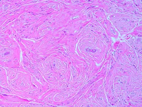 Pathologie van angiomyofibroblastoom