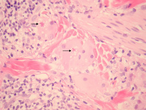 Patología del granuloma elastolítico anular de células gigantes