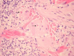 Pathologie van reuzencel annulair elastolytisch granuloom