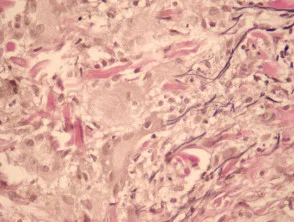 Pathologie van reuzencel annulair elastolytisch granuloom