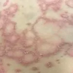 annulair-erythema-01__protectwyjqcm90zwn0il0_focusfillwzi5ncwymjisinkildg1xq-9581109-7560063-jpg-9580642