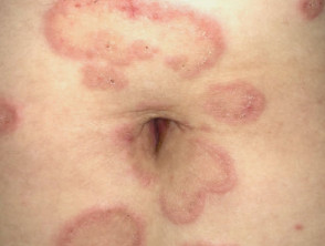 Zentrifugales Erythema annulare