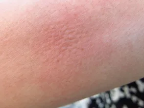 Reacción de urticaria localizada a las hormigas