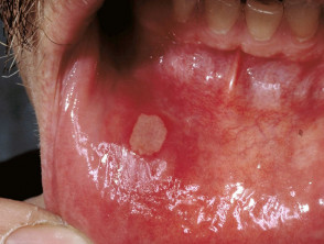 Ulceración aftosa