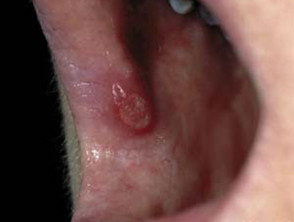 Ulceración aftosa