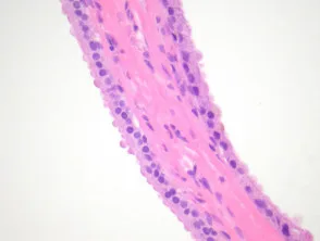 Pathologie van apocriene hydrocystoma