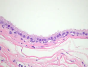 Pathologie van apocriene hydrocystoma