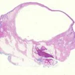 apocrine-hydrocystoma-figure-1__protectwyjqcm90zwn0il0_focusfillwzi5ncwymjisingildvd-7293986-3956614-jpg-9225141