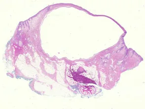 Pathologie van apocriene hydrocystoma