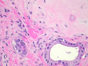 Patología del tumor mixto apocrino (siringoma condroide apocrino)