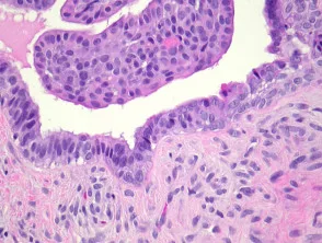 Patología del tumor mixto apocrino (siringoma condroide apocrino)