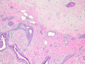 Patología del tumor mixto apocrino (siringoma condroide apocrino)