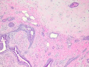 Patología del tumor mixto apocrino (siringoma condroide apocrino)