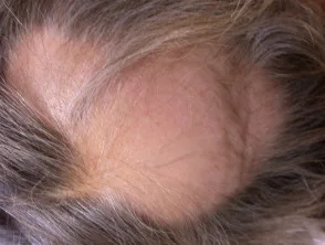 Alopecia areata