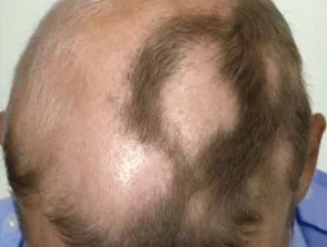 Alopecia areata