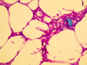 Aspergillus PAS-kleuring