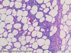 Patología de la aspergilosis