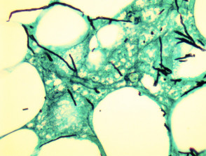Patología de la aspergilosis tinción GMS