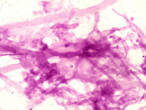 Tinción PAS de aspergillus observada en una biopsia de piel