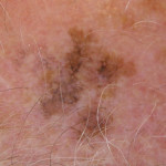 El melanoma tiene asimetría