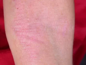 Eczema atopico