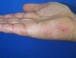 Eczema atopico