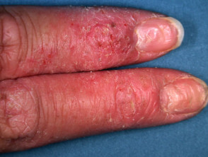 Eczema atopico