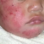 at-derm1__protectwyjqcm90zwn0il0_focusfillwzi5ncwymjisingildfd-8504067-9340169-jpg-6072762