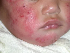 Eczema atopico