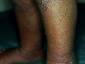 Eczema atopico