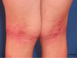 Eczema atopico