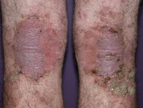 Dermatitis infectada