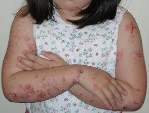 Eczema atopico