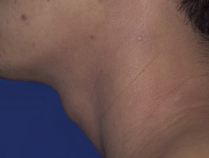 Dermatitis atópica del cuello