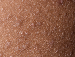 Nahaufnahme einer follikulären atopischen Dermatitis