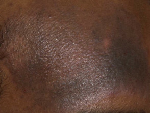 Hiperpigmentación por eccema atópico en piel negra