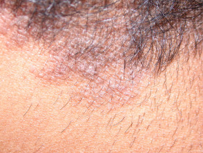 Dermatitis atópica del cuero cabelludo