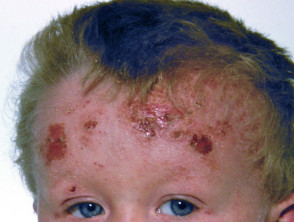 Dermatitis atópica del cuero cabelludo