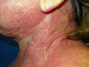 Dermatitis atópica que afecta al cuello