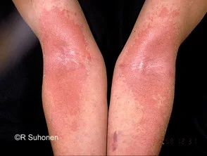 Atopische dermatitis