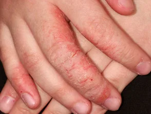 Atopische dermatitis