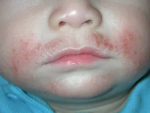 Atopische dermatitis